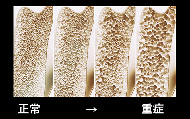骨粗鬆症